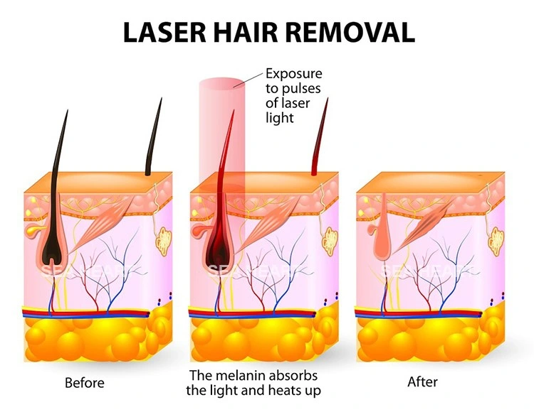 Long Pulsed ND YAG Laser Machine for Hair Removal&Vascular Lesion