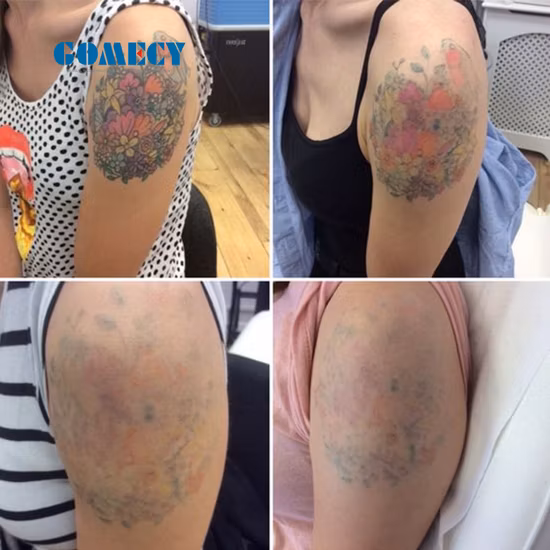 Picosegundo portátil ND YAG Eliminación de tatuajes con láser Peeling de carbono