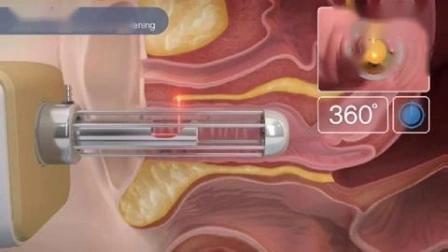 Tubo de RF de metal Eliminación de estrías Estiramiento vaginal Láser de CO2 fraccionado Láser de CO2 fraccionado Estiramiento vaginal Rejuvenecimiento de la piel Láser de CO2 fraccionado